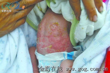 婴儿使用强生沐浴露后得疱疹 强生称因个体差